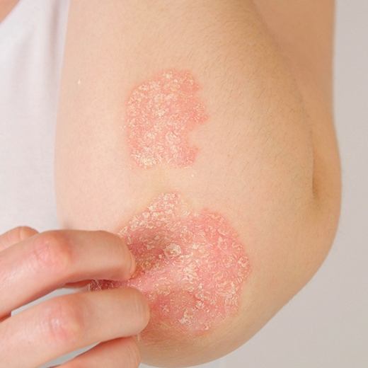 Body Sugaring and Psoriasis