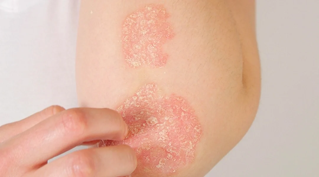 Can Sugaring Help with Psoriasis?