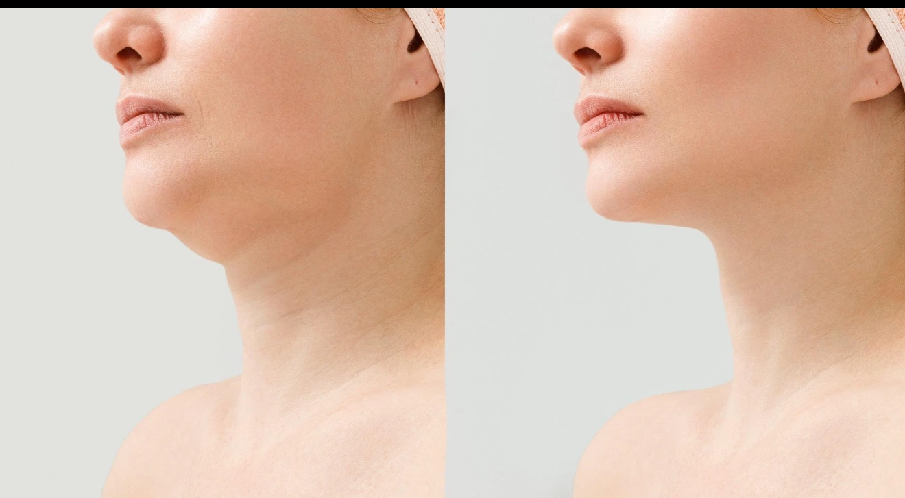Client consulting with aesthetic provider about neuromodulator treatment options